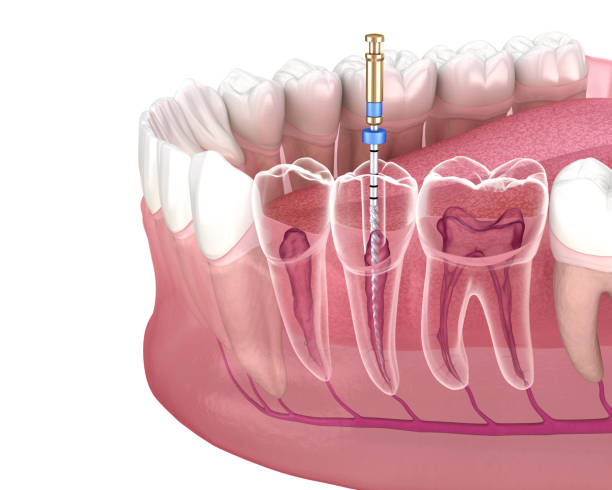 Painless Root Canal Treatment